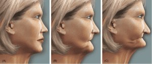 ozempic dental considerations - loss of VDO