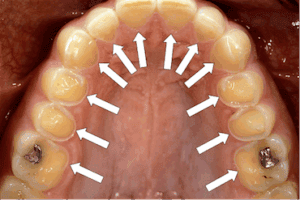 Erosion-from frequent vomiting