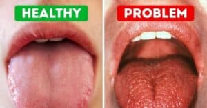 ozempic dental side effects can be seen when the issues become severe